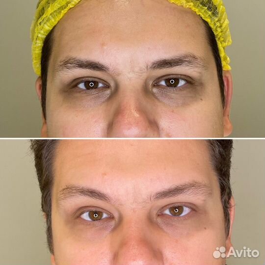 Холодная плазма, омоложение, лечение целлюлита