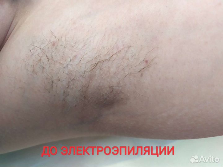 Шугаринг, электроэпиляция