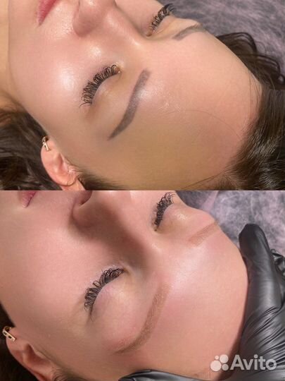 Лазерное удаление татуажа, перманента, тату