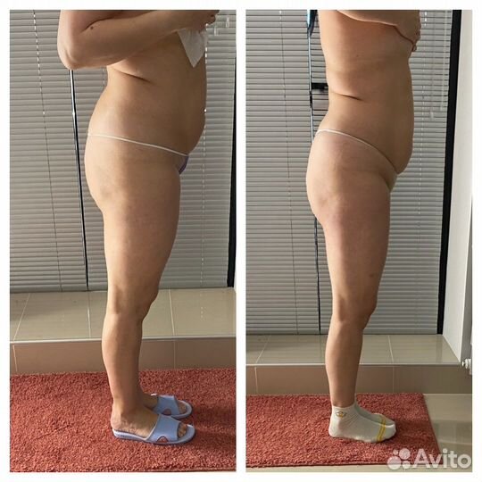 Карамельная липосакция.Аппаратный массаж