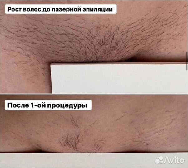 Лазерная эпиляция без боли