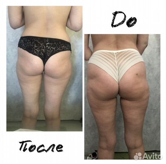 Массаж антицеллюлитный,лимфодренажный,буккальный