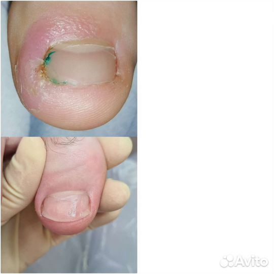 Педикюр подолог