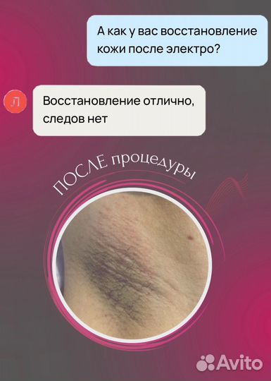 Электроэпиляция