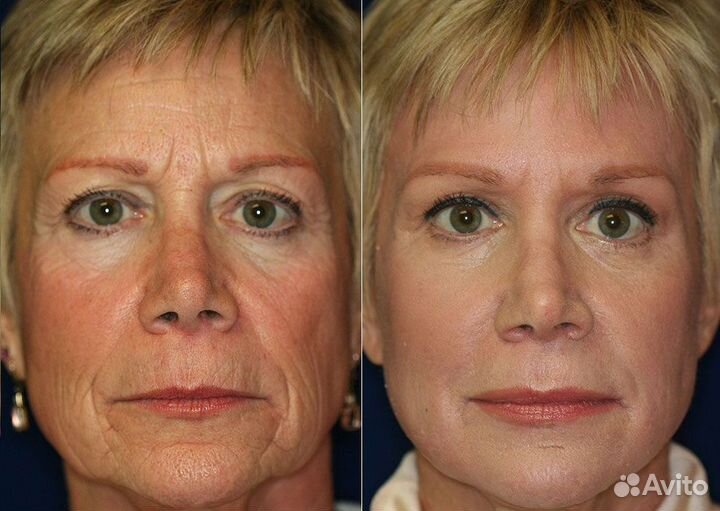 Требуются модели на мезотерапию лица бесплатно