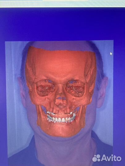 Моделировка в exocad