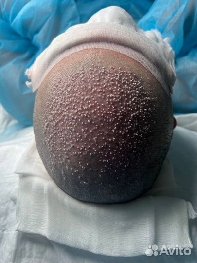 Пересадка волос за 1 день