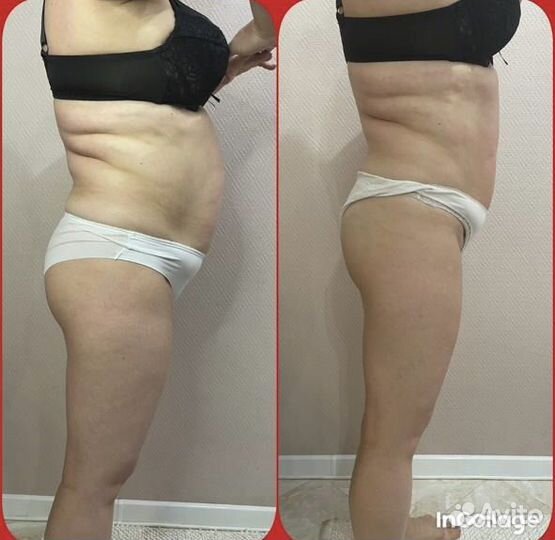 Аппаратный массаж