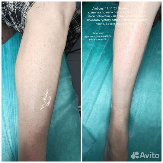 Электроэпиляция для женщин в Семилуках