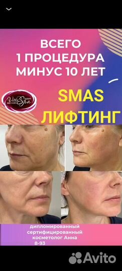 Безоперационная блефаропластика век