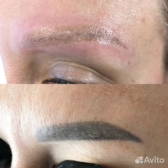 Удаление татуажа лазером