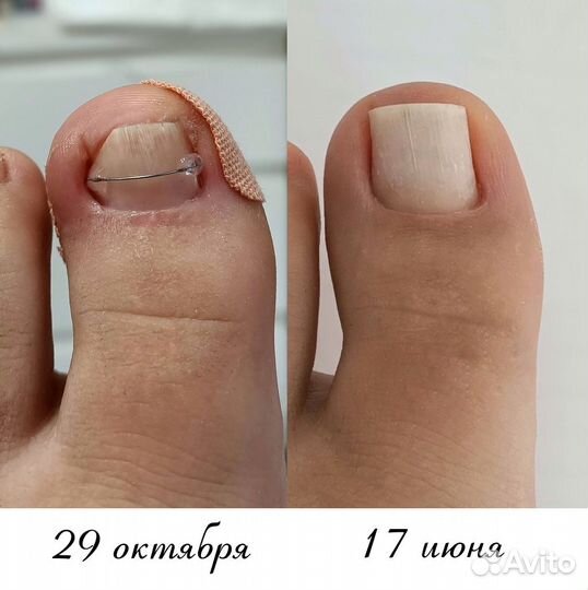 Подолог, титановая нить, вросший ноготь. Азино