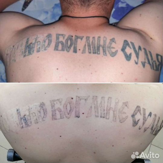 Удаление татуировок и татуажа. Карбоновый пилинг