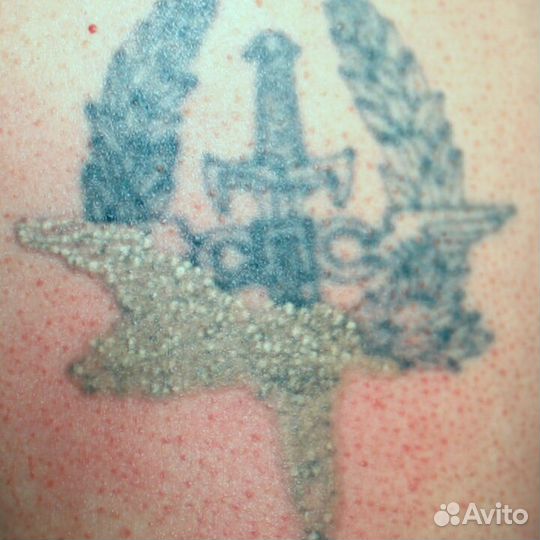 Лазерное удаление татуировок и татуажа бровей