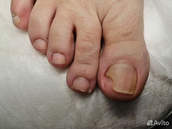 Титановый нити Light system коррекционная система