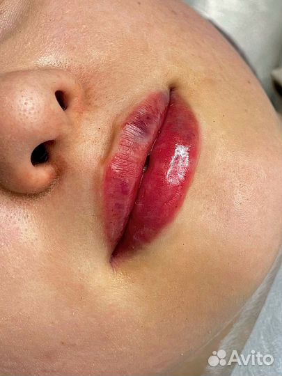 Увеличение губ