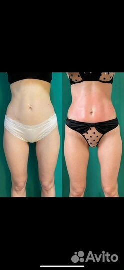 Аппаратный массаж, похудение, коррекция фигуры