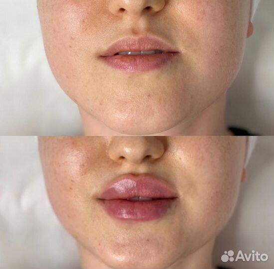 Увеличение губ