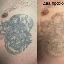 Лазерное удаление тату / татуажа бровей Москва, Москва
