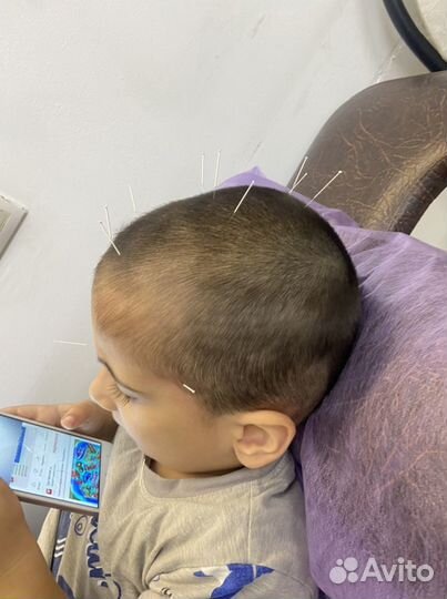 Иглотерапия