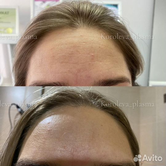 Холодная плазма