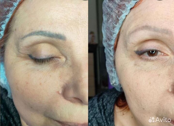 Удаление старого татуажа или тату