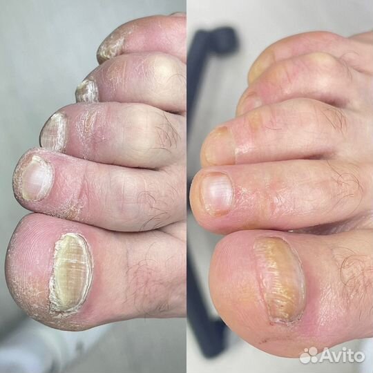 Аппаратный педикюр / Подолог