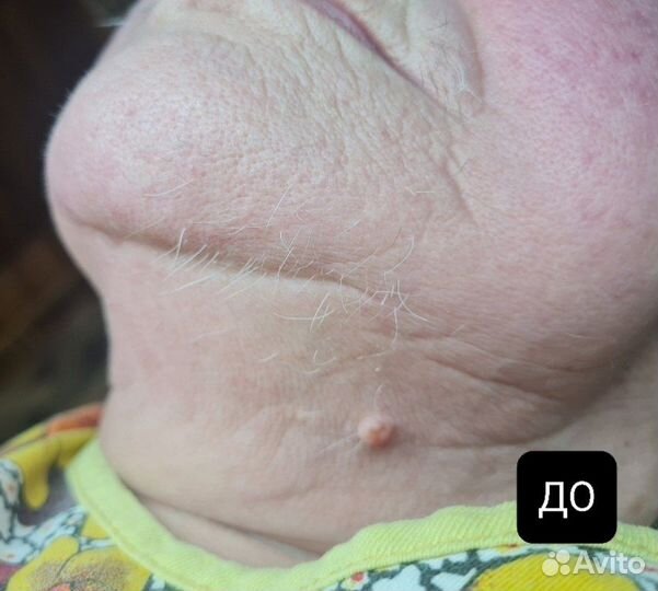 Электроэпиляция