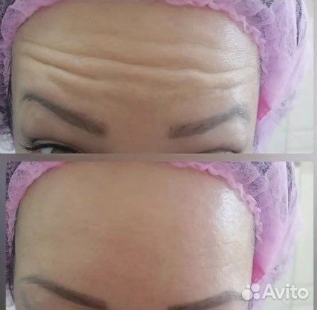 Инъекции ботокса по лицу