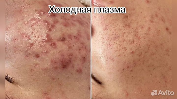 Холодная плазма