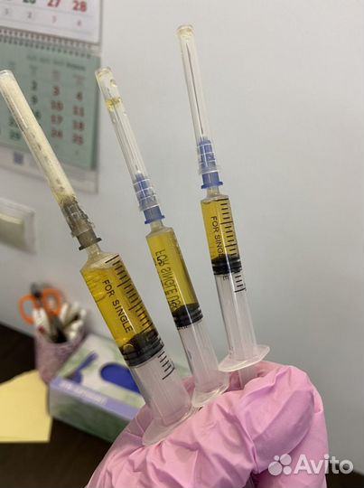 Иглотерапия