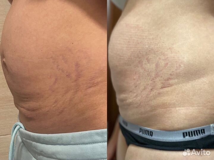 Омоложение кожи горячей плазмой, подтяжка кожи