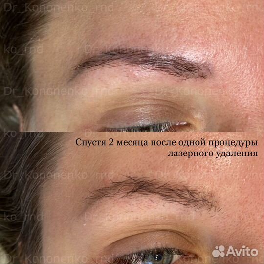 Удаление татуажа бровей