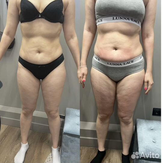 Lpg,коррекция фигуры