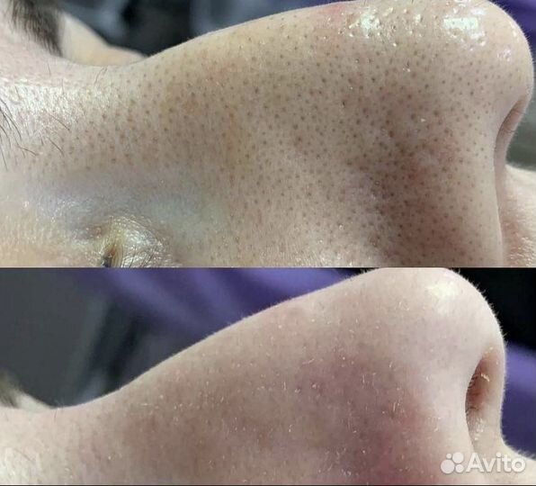 Шугаринг: руки выше локтя