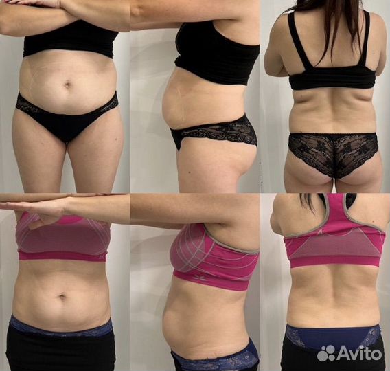 Модель на криолиполиз быстрое похудение