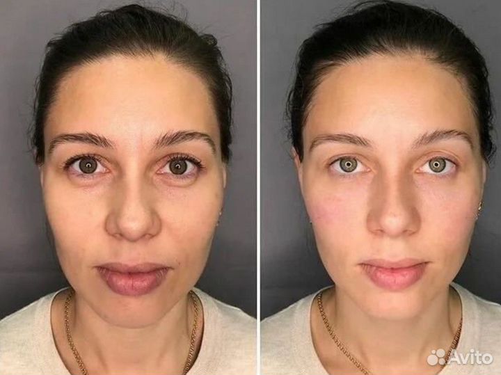 Модель на РФ лифтинг лица