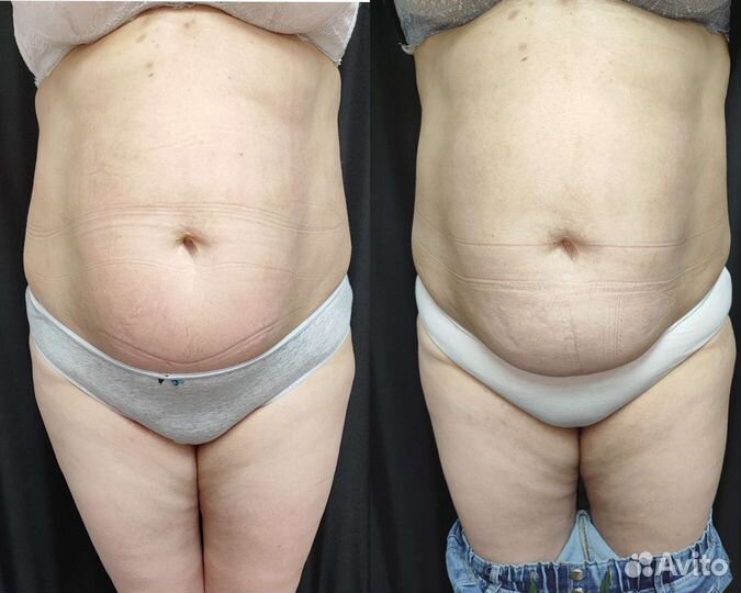Подтяжка живота