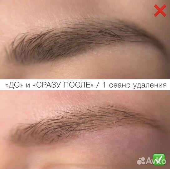 Лазерное удаление тату и татуажа бровей