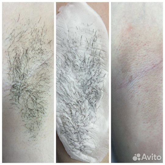 Эпиляция и депиляция