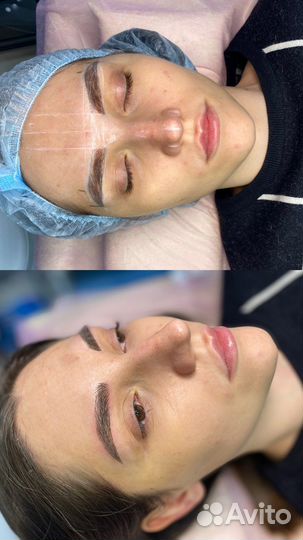 Микроблейдинг