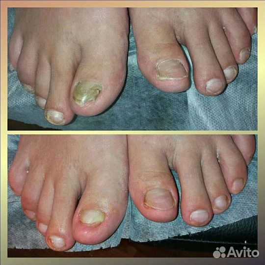 Педикюр любой сложности