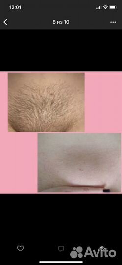 Шугаринг: руки выше локтя