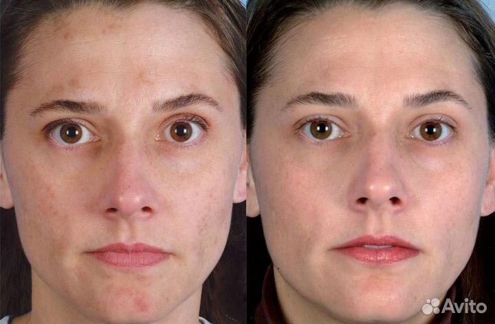 Модели на Криомассаж лица бесплатно