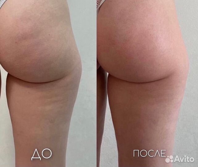 Антицеллюлитный массаж