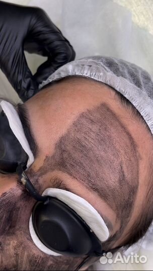 Удаление тату и перманентного макияжа