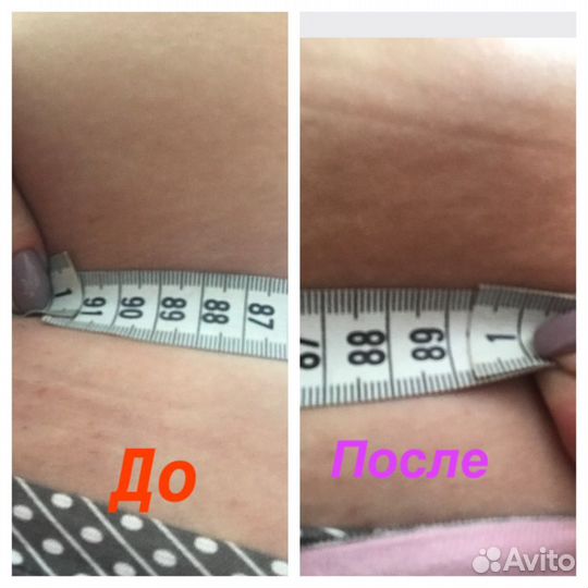 Кавитация, вакуумный массаж,RF-лифтинг, липолиз