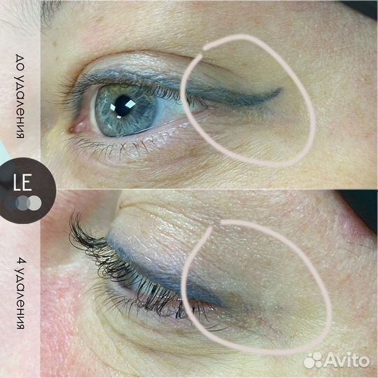 Удаление татуажа/тату на пикосекундном лазере