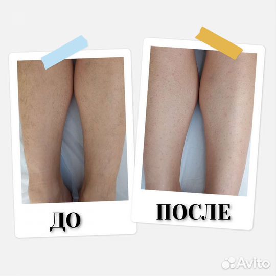 Депиляция воск/сахар