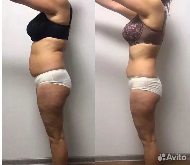 Удаление жира, криолиполиз в Белгороде